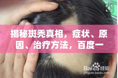 揭秘斑秃真相，症状、原因、治疗方法，百度一搜便知！